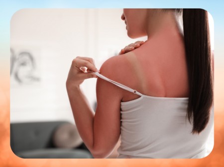 Ήλιος και Εγκαύματα: Προστασία και Θεραπεία